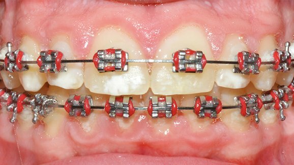 Protocollo sperimentale per la gestione dei tessuti duri durante il trattamento ortodontico