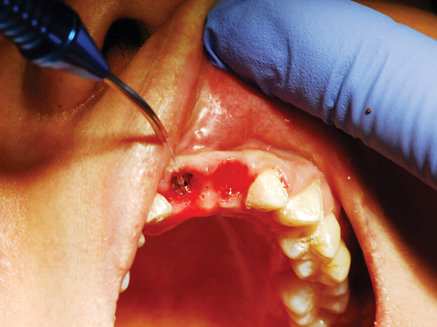 Fig. 7: Occlusal view of the anterior maxilla demonstrating preservation of the papilla due to the provisional bridge. (Photo provided by Dr. Gregori M. Kurtzman)