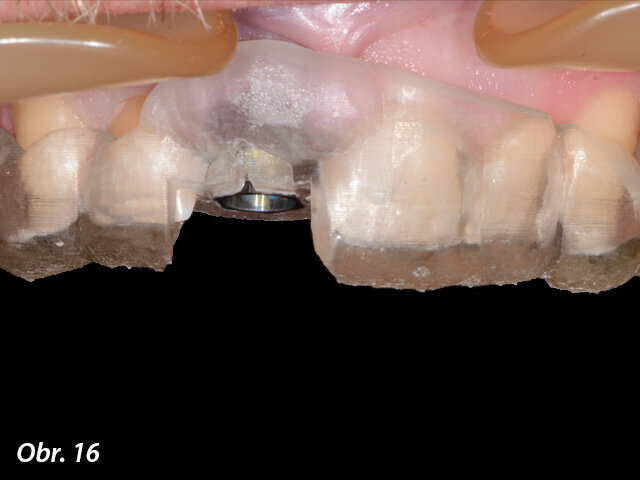 Chirurgická šablona umístěná na zubech pacienta.
