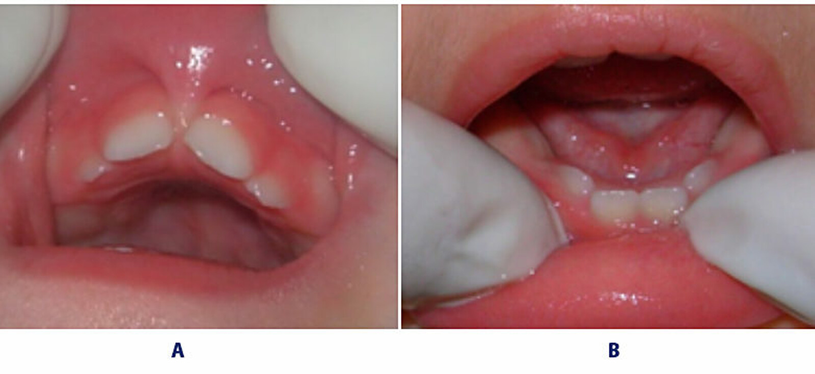 Figuras n Â° 3a y 3b. ConstricciÃ³n maxilar (forma triangular) que condiciona el apiÃ±amiento dentario.