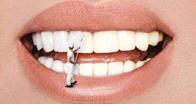 Istraživanje sugerira da upotreba nanočestica može biti bolji način za izbjeljivanje zuba