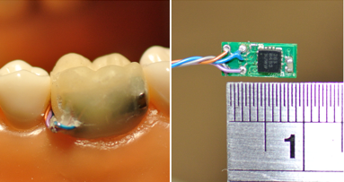 Sensor dental chinês pode facilitar o monitoramento do paciente