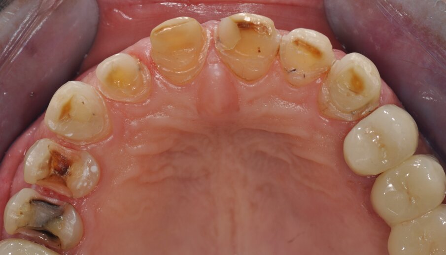 Fig. 5: Preparation of the partial crowns and the veneers, occlusal view