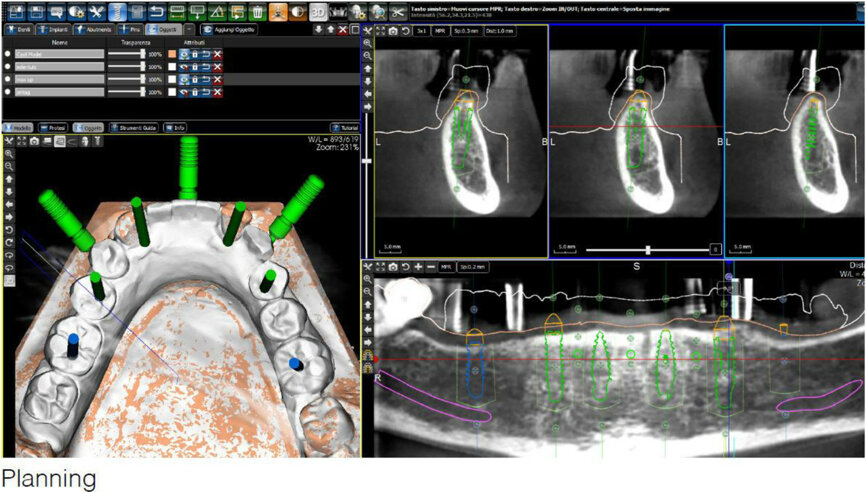Fig. 4: Screenshot of the virtual implant planning for positions #36, 35, 33, 42 and 46, showing occlusal, sectional and panoramic views.
