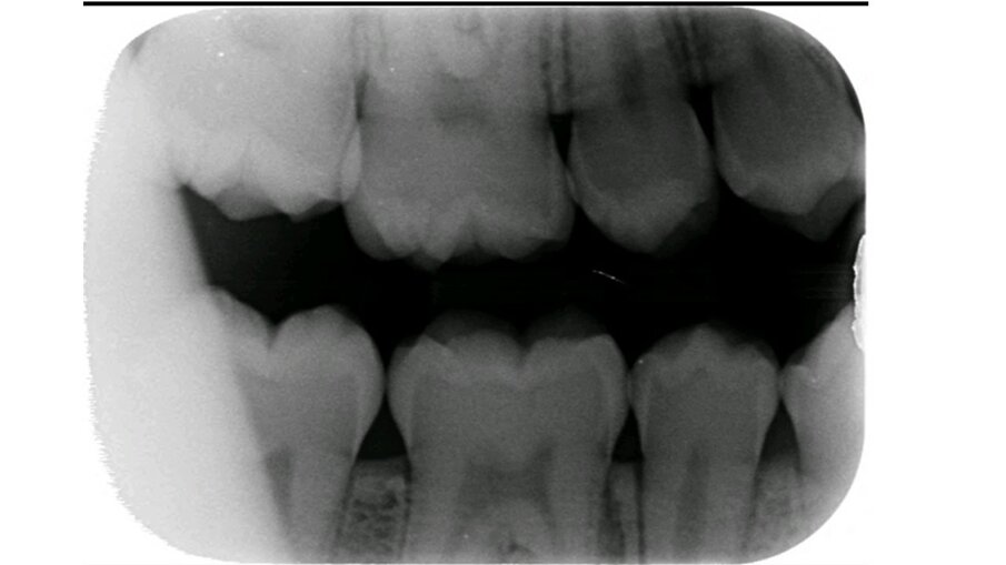 Afbeelding 2a. Bitewings van de blijvende dentitie. 