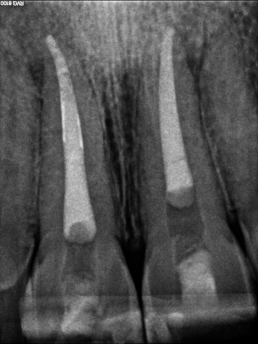 Fig. 7: Four months follow-up radiograph.