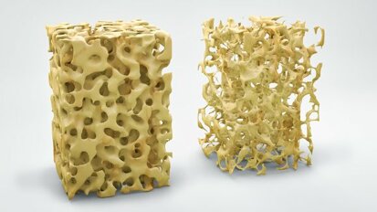 Разтворими магнезиеви импланти могат да подобрят костообразуването при остеопороза