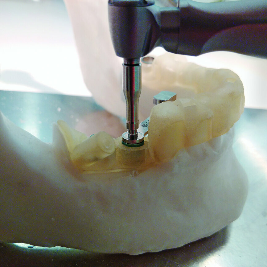Fig. 5: Drill attached to the extension passing through the reduction sleeve. The extension allows the drill to be guided correctly without touching the template on the adjacent tooth with the contra-angle handpiece. Clinically, the use of the drill extension may be impossible, especially in molars, owing to the limited opening of the jaws.