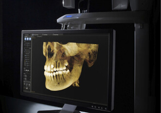 Carestream Dental introduces CS 9300-1