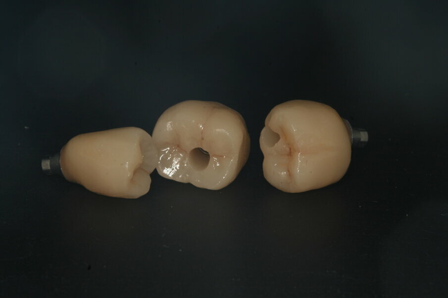 Fig. 20: IPS e.max CAD abutment crowns before being screwed into place