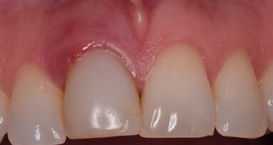 La regeneración alveolar en dientes anteriores