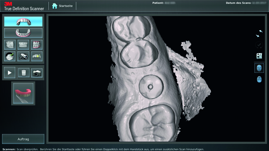 Fig. 8: The clinical situation in the CAD software digitized with the 3M True Definition Scanner. The implant is inserted into the prepared bone bed.