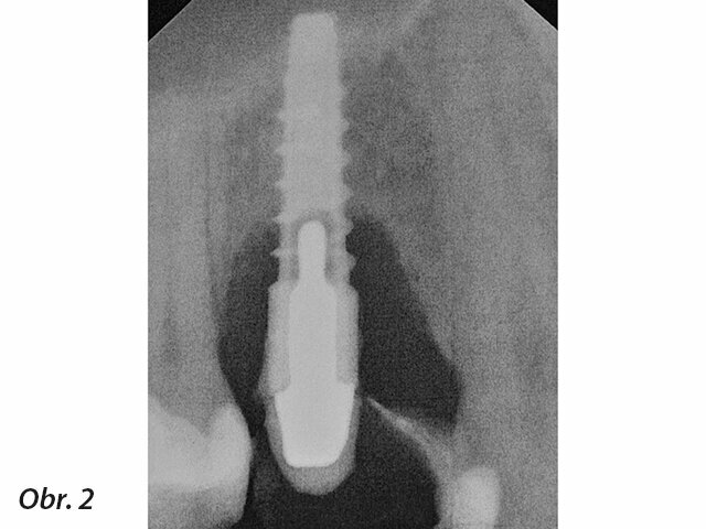 Intraorální rentgenový snímek téhož implantátu