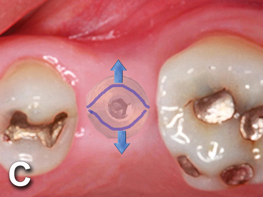 Fig. 4c: Implant to be uncovered (4a) presents with two options depending on width of attached gingiva available. Wide band of attached gingiva will remain after removal of tissue over cover screw, and the diode is utilized in a spiral pattern starting at center until fully exposed (4b). With the narrow band of attached gingiva present, an elliptical cut is made with the diode and tissue is pushed buccally and lingually to preserve the attached gingiva (4c). (Photo provided by Dr. Gregori M. Kurtzman)