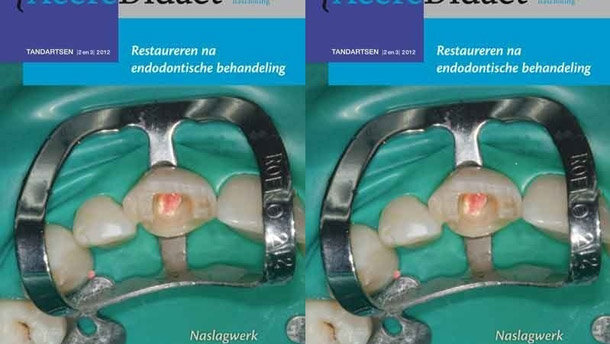 Veelbelovende aanpak bij restaureren na endodontie