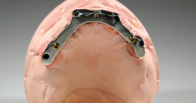 Overdenture su barra implanto-supportata