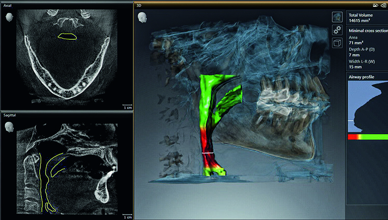 Fig. 1: Upper airway visualized in SICAT Air. (Images: Dentsply Sirona)