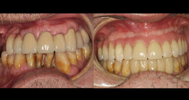 Tratamiento con “all-on-four” de paciente con dentición terminal