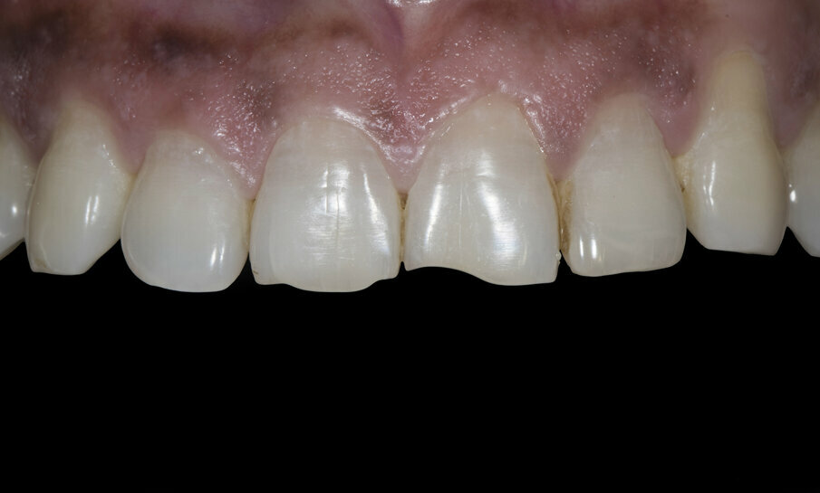 Fig. 1: Fractured maxillary anterior incisal edge of tooth #11 and 21