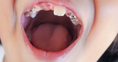 Relatório de Porirua indica disparidade na saúde bucal das crianças
