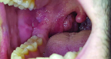 Lesioni orali trattate con un particolare olio ozonizzato (Ialozon): 2 case report