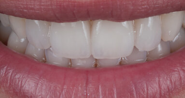 Struttura superficiale: Utilizzo di linee orizzontali e verticali per simulare l’aspetto naturale del dente – Teoria e procedura tecnica