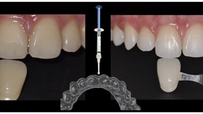 Los efectos en dientes tratados con endodoncia