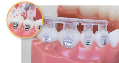 Providing orthodontists with clinical freedom and workflow efficiency