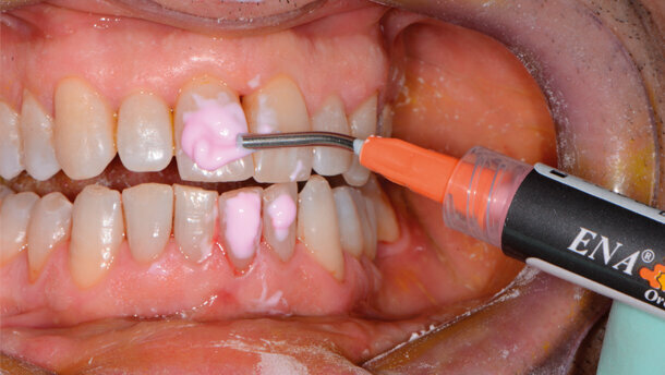 Il trattamento di sbiancamento autogestito dal paziente. Un rischio per la salute del cavo orale. Case report