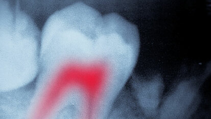 Une étude révèle que la douleur post-traitement endodontique a différentes sources