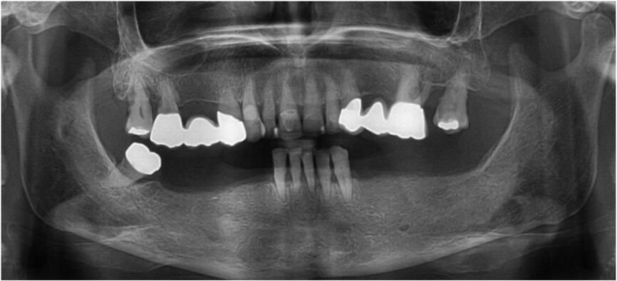 Fig. 1: Panoramic radiograph of the initial dental status.