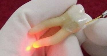 Przeciwbakteryjne działanie laserów w leczeniu endodontycznym