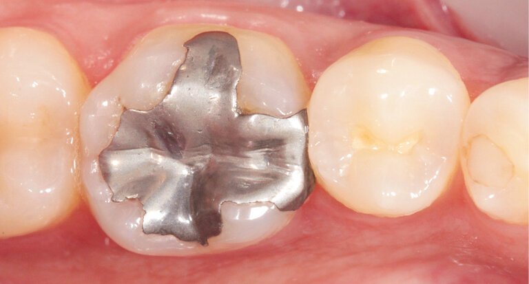 Fig. 1: Preoperative situation: defective amalgam filling on tooth 36