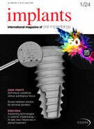 implants international No. 1, 2024