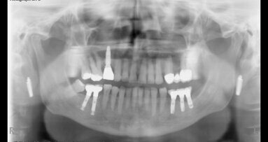 Míra úspěšnosti dentálních implantátů u těžkých kuřáků. Dlouhodobá studie
