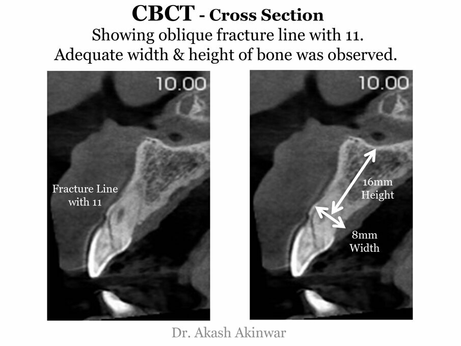 Fig 6: CBCT - Crown section