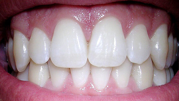 Cruciaal kenmerk dentale stamcel ontdekt