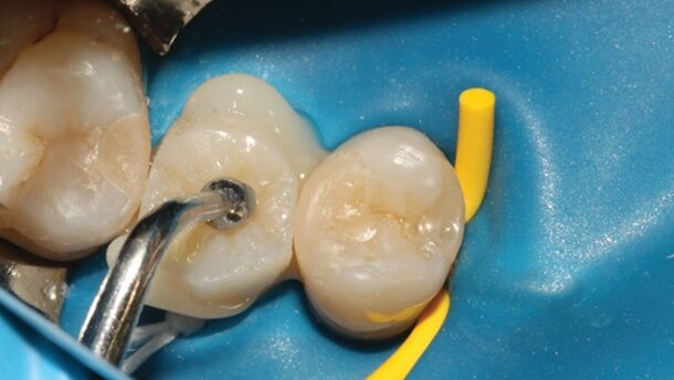 Retraitement endodontique et restauration collée d’une seconde prémolaire structuralement compromise