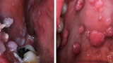 Fig. 6. Verrugas y condilomas. Los pacientes con SIDA suelen presentar múltiples lesiones de VPH en mucosa genital y bucal, asociadas a inmunosupresión.