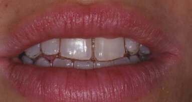 Protocolli di igiene orale per la bellezza e la salute del sorriso nel paziente ortodontico