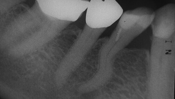 Racine en S – risques relevant d’un défi majeur en endodontie