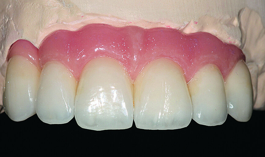 Fig. 34: After fitting of the zirconia framework, the ceramic was cast using the exact parameters validated by the resin prosthesis.