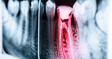 Istraživači planiraju da razviju senzor za pametni telefon kako bi otkrili bol u zubima