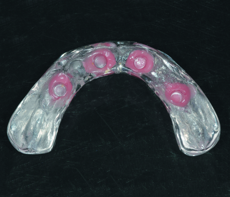 Fig. 18: Laboratory processed, clear duplicate prosthesis with siliconised reline material to improve retention; to be used as a night-time appliance to protect the tongue from the sharper edges of the abutments.