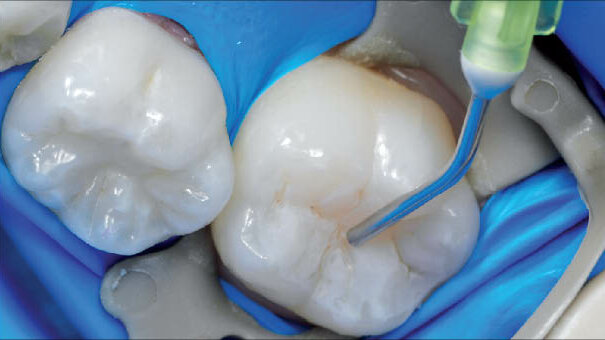 Kompobond: Vývoj nového dentálního výplňového materiálu – část II.