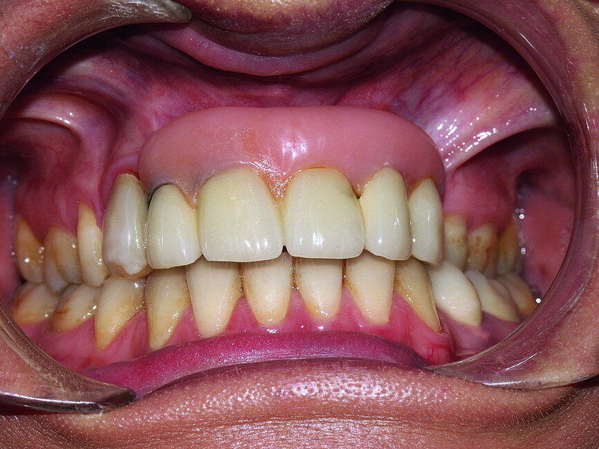 Fig. 1 : Initial prostheses: Lip support was ensured by a large false gingiva, and fractured cosmetic material at the right maxillary canine was evident. The patient’s smile showed the prosthetic teeth placed off-centre and an infiltration at the right lateral incisal level.