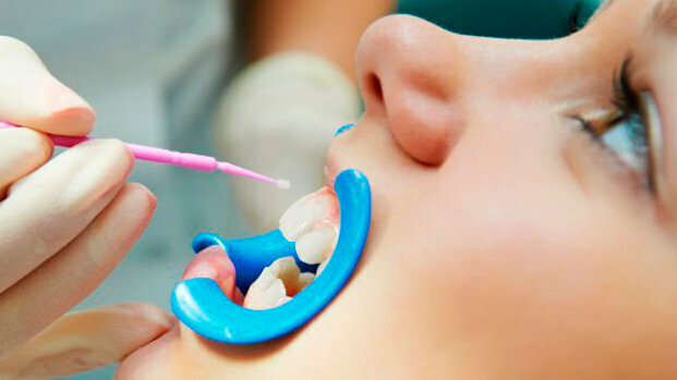 Nella prevenzione della carie, i sigillanti dentali a confronto con le vernici al fluoro