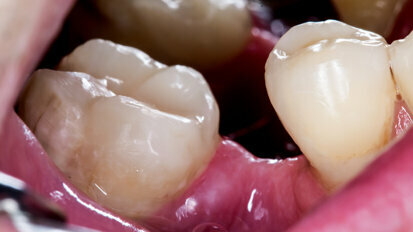 Rast novih zubi: Istraživači slijede 