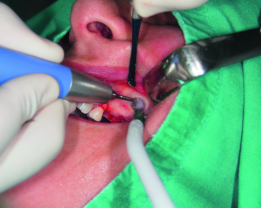 Fig. 5: Lateral window access to the maxillary sinus.
