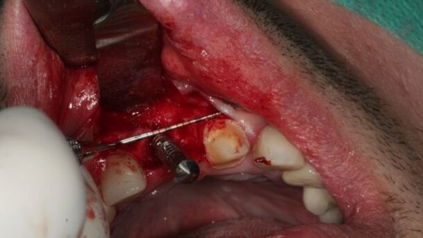 Leczenie implantoprotetyczne pojedynczych braków zębowych – opis przypadków